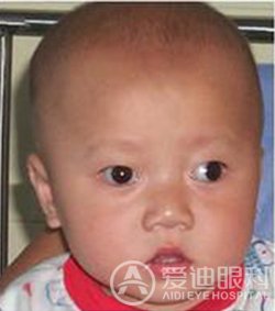 小儿斜视