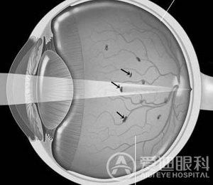 飞蚊症病因和并发症